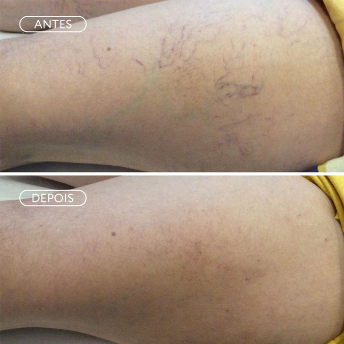 Botox - Amo Estética Natal/RN