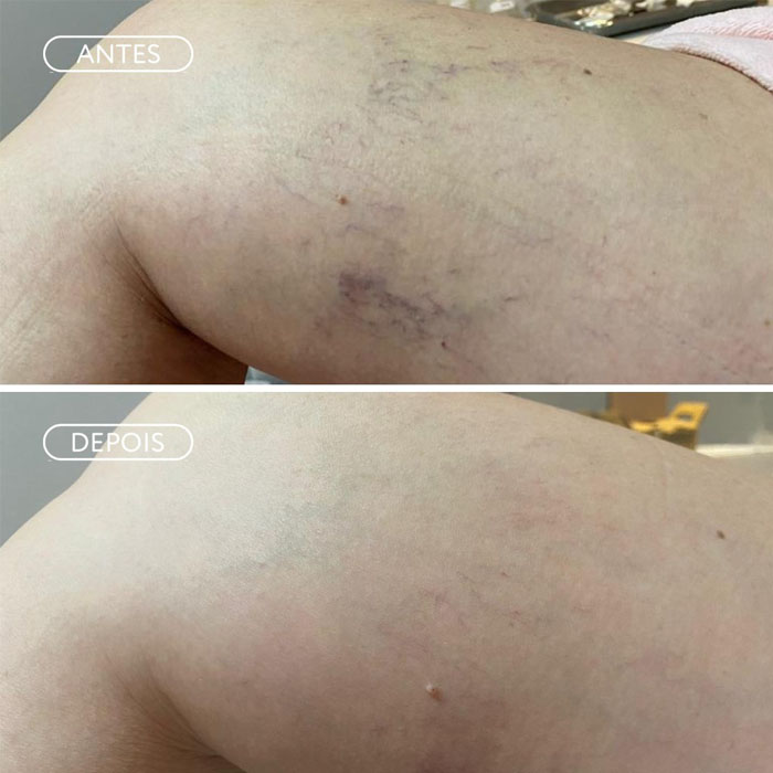Resultado Preenchimento - Harmonização facial