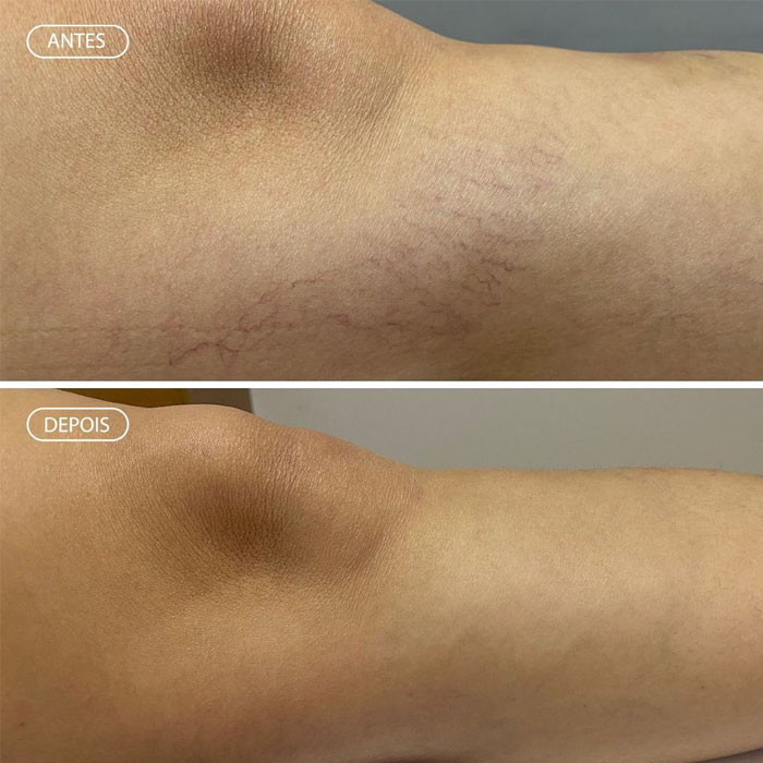 Resultado Preenchimento - Preenchimento labial