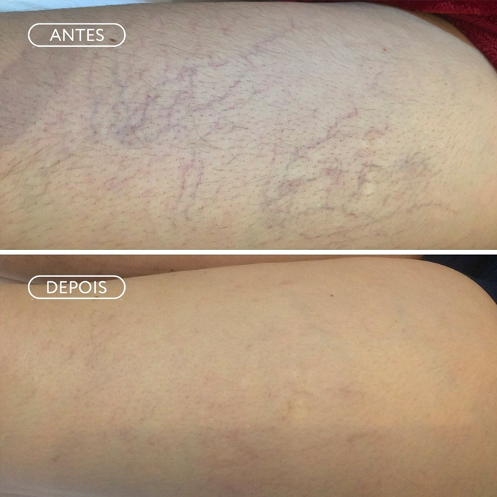 Resultado Preenchimento - Contorno facial